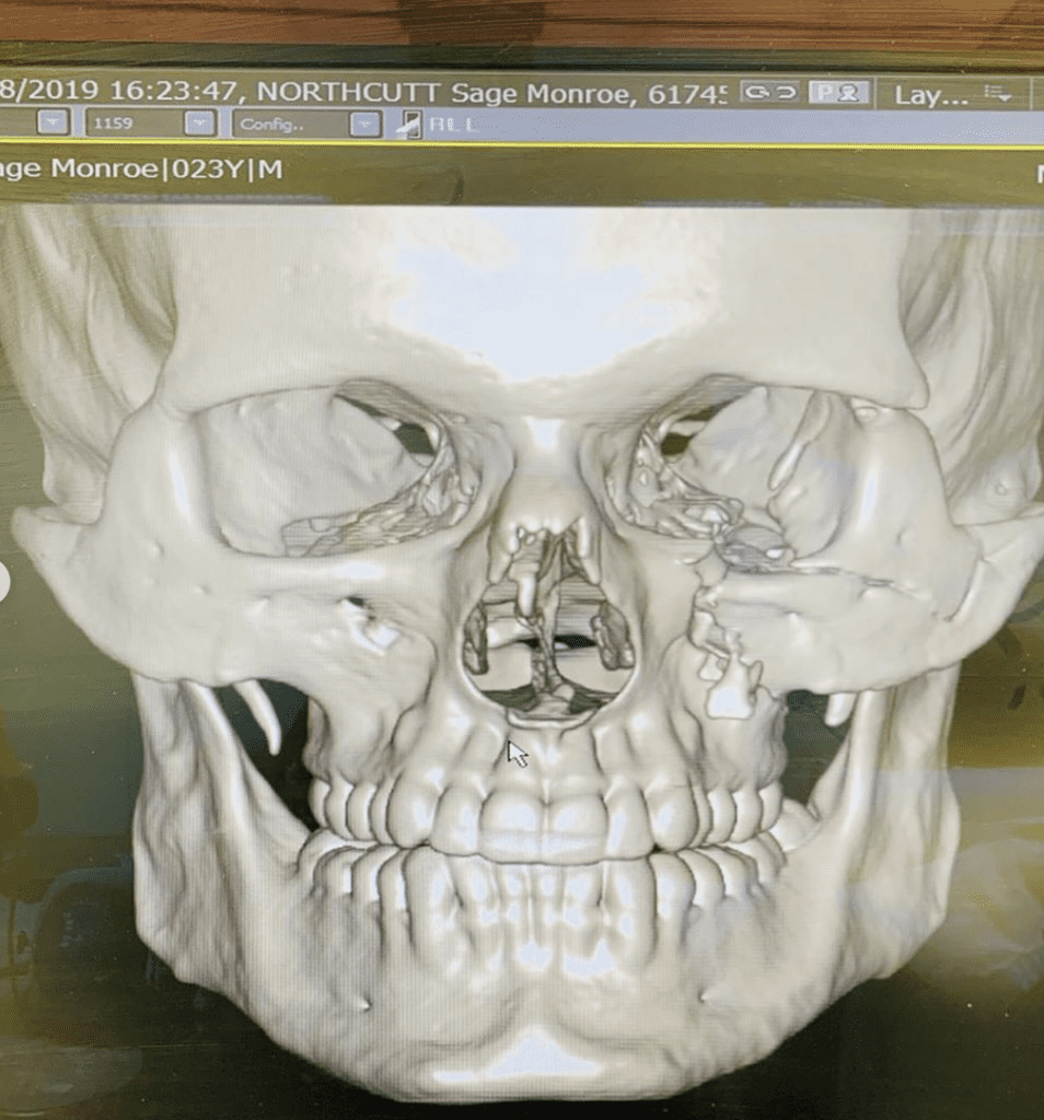 Sage Northcutt suffered 8 fractures in ONE Championship loss; Had 9