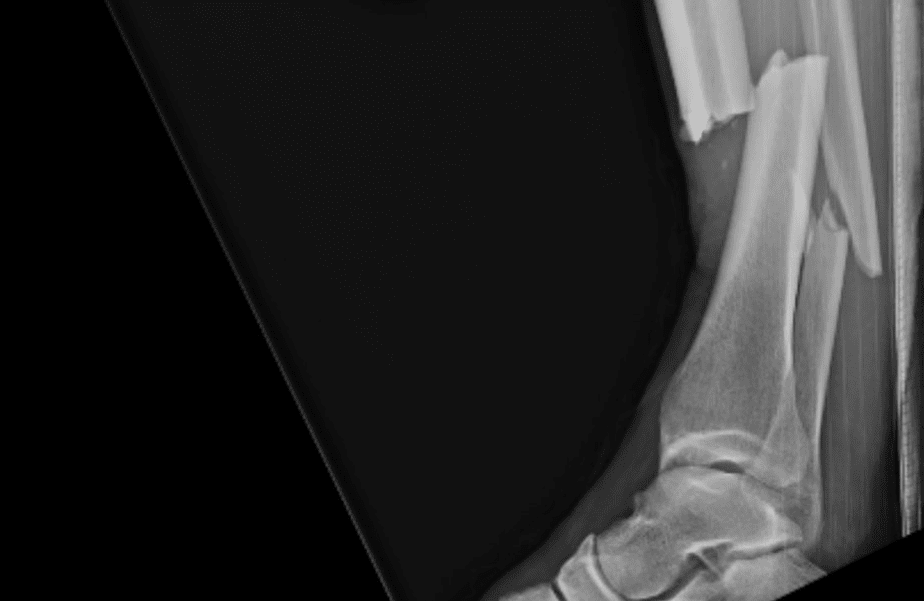 anderson silva broken leg x ray